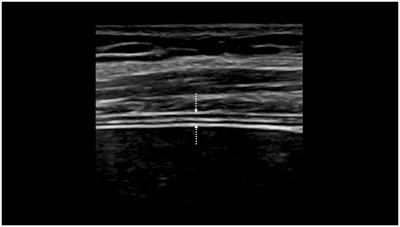 Diagnosis of hemidiaphragm paralysis: refine ultrasound criteria